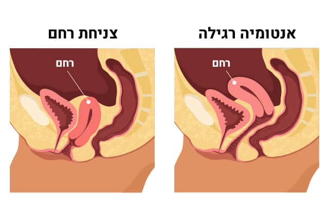 Uterine prolapse Picture